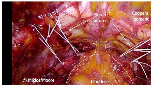 Laparoscopic Burch