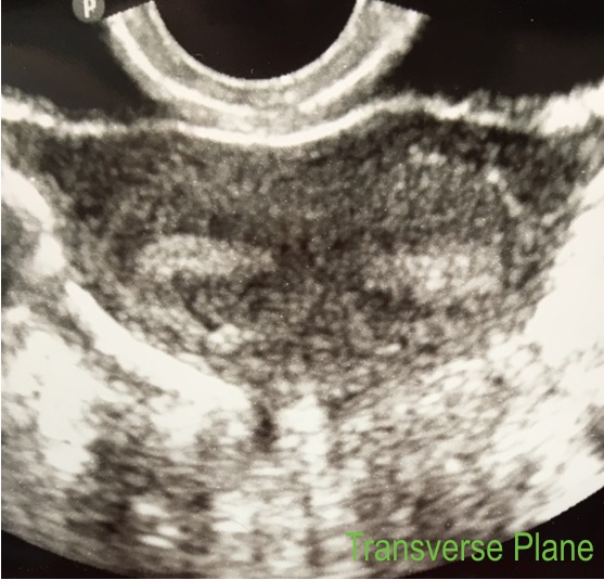 Four Tips For Correctly Diagnosing Uterine Anomalies