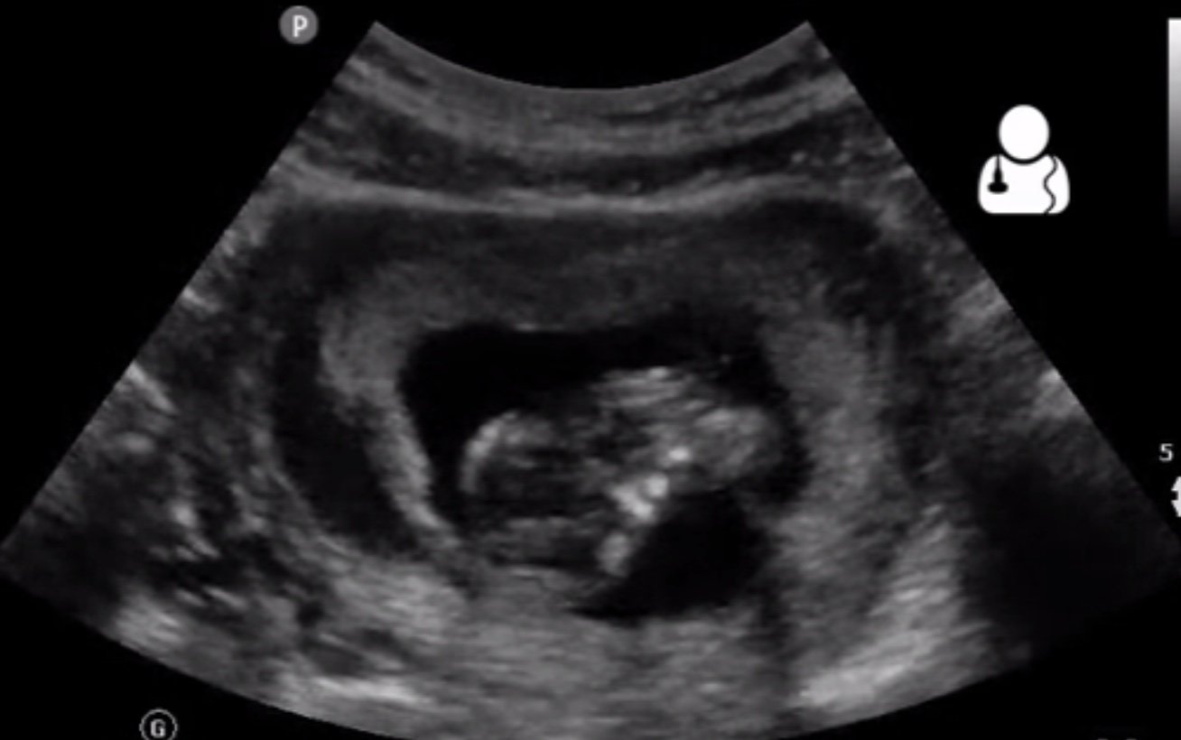 The significance of ultrasound features of sub-chorionic