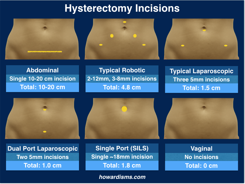 Healing Time After Robotic Hysterectomy