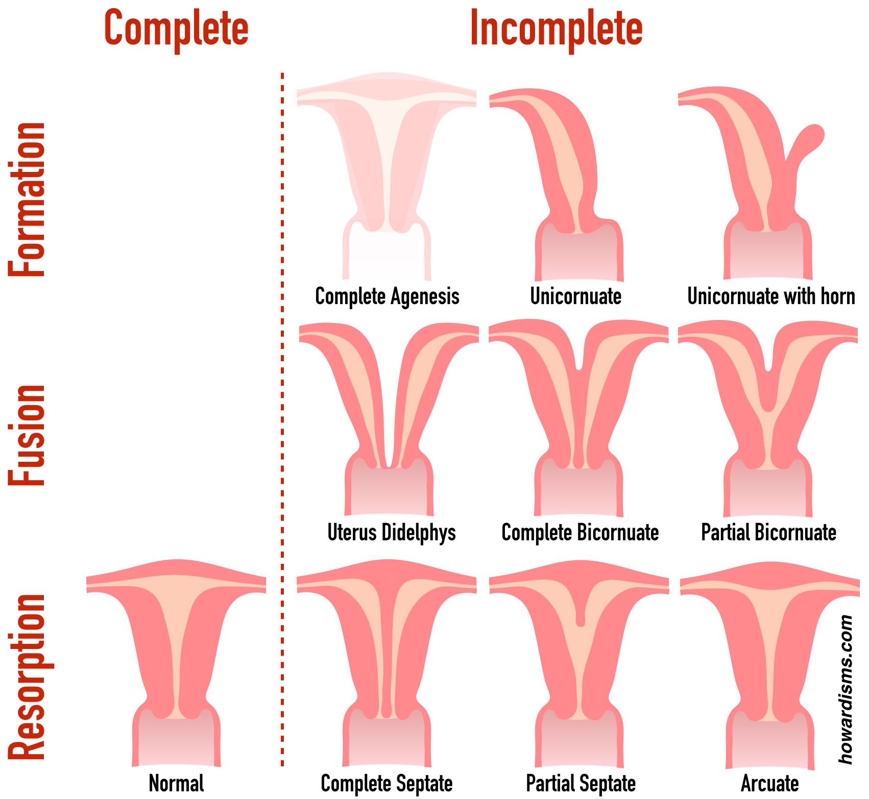 Arcuate Uterus Ultrasound