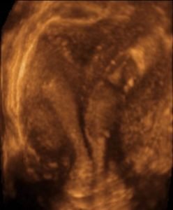 Four Tips For Correctly Diagnosing Uterine Anomalies